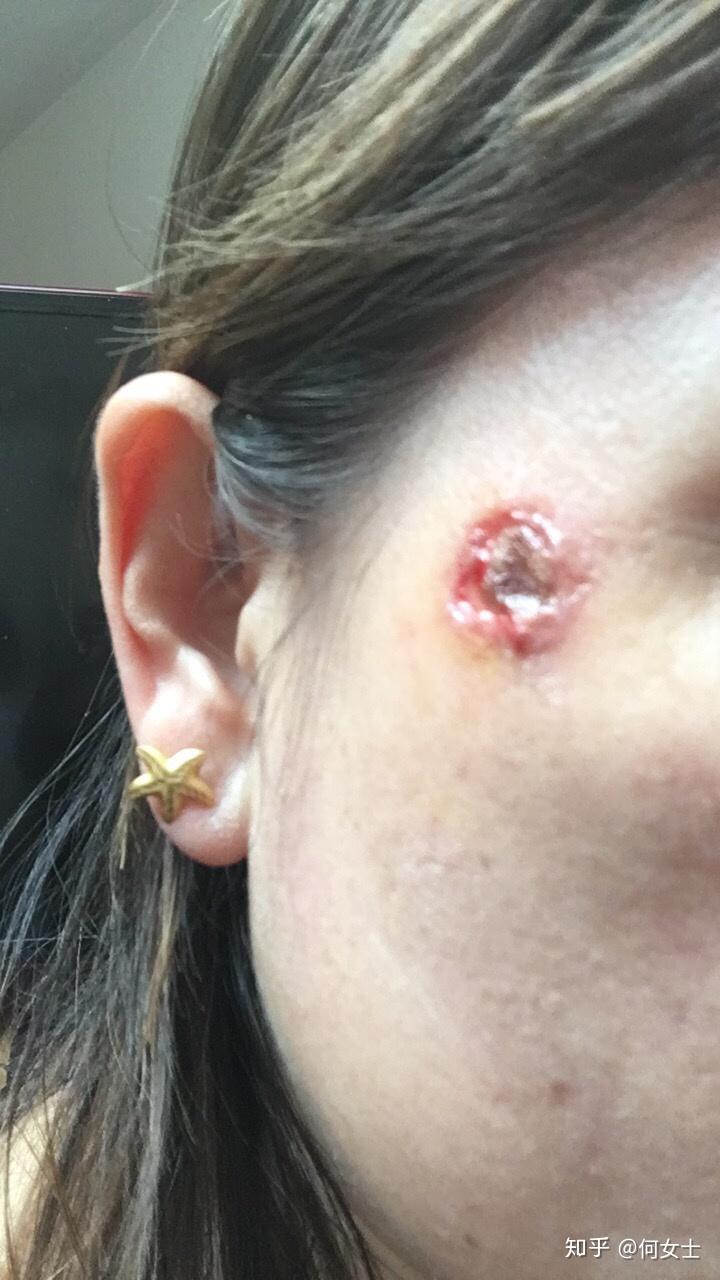 为什么点完痣用了两天消毒液后用修复液一涂修复液就流脓