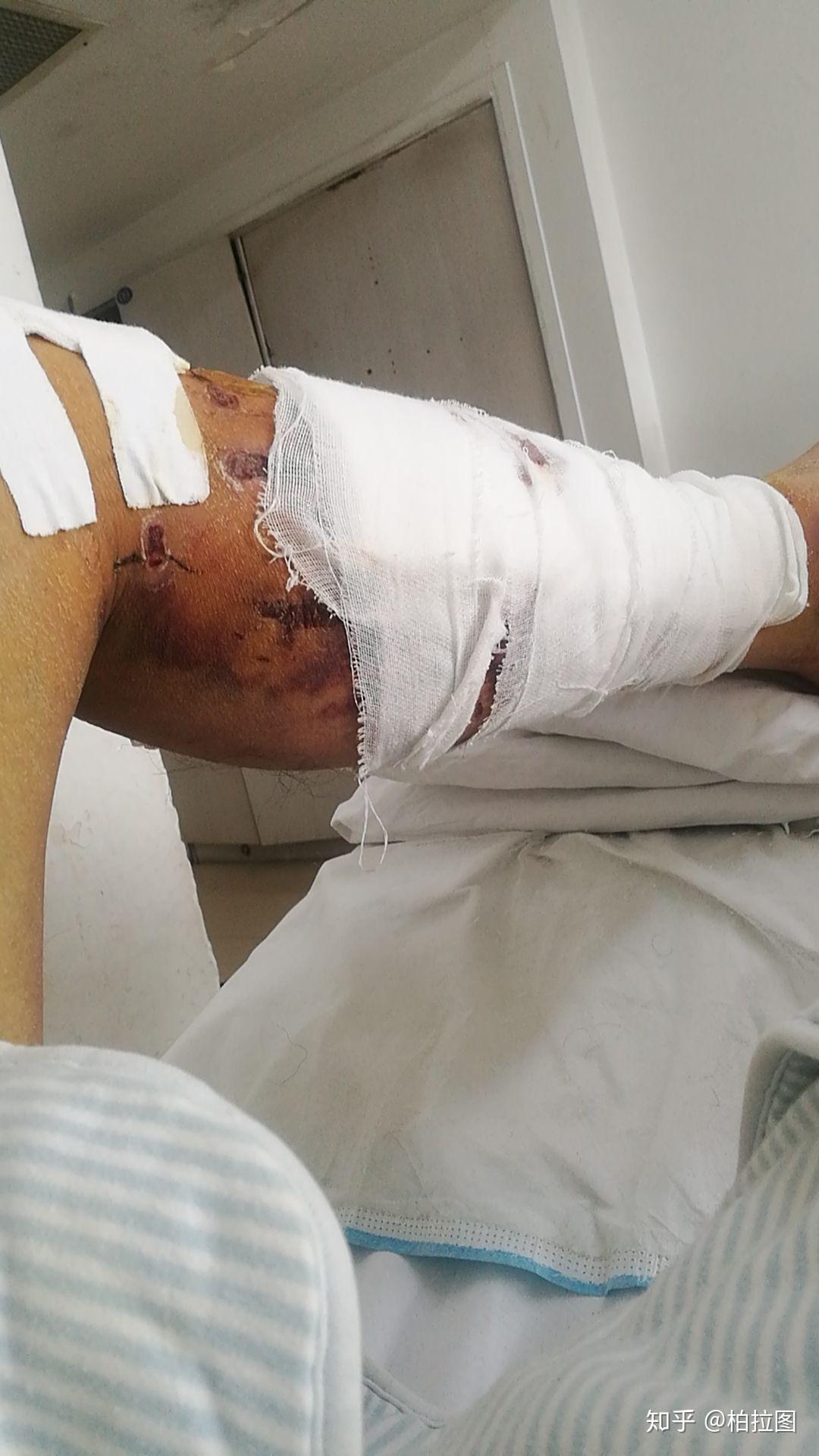 胫骨骨折的你们最后怎么样了