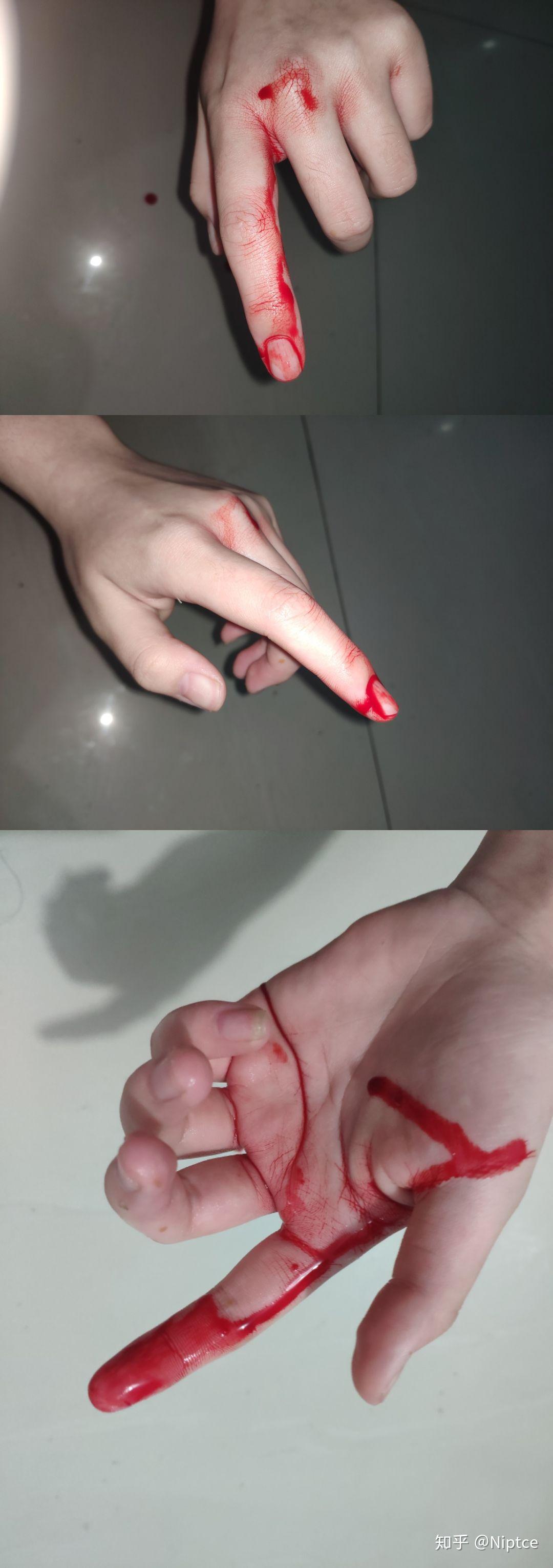 切菜切到手该怎么办