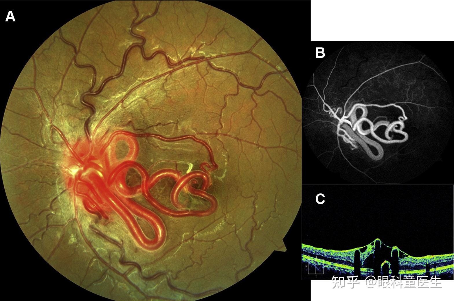 视网膜母细胞瘤照片图片