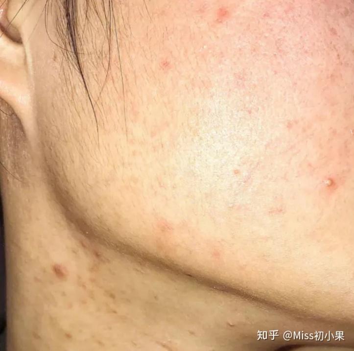 休眠火山痘攻略