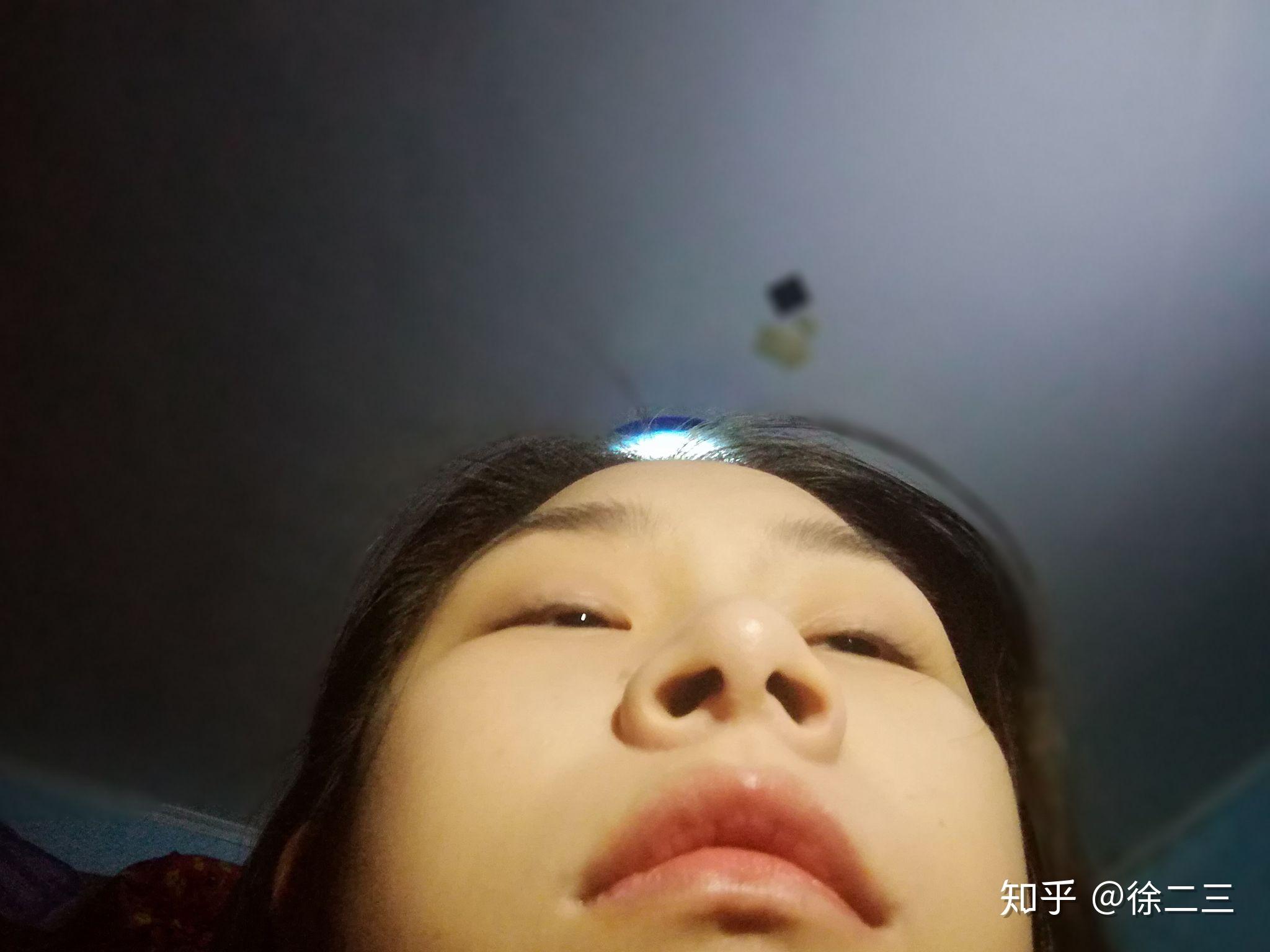 鼻孔挖大了怎么办还能恢复吗