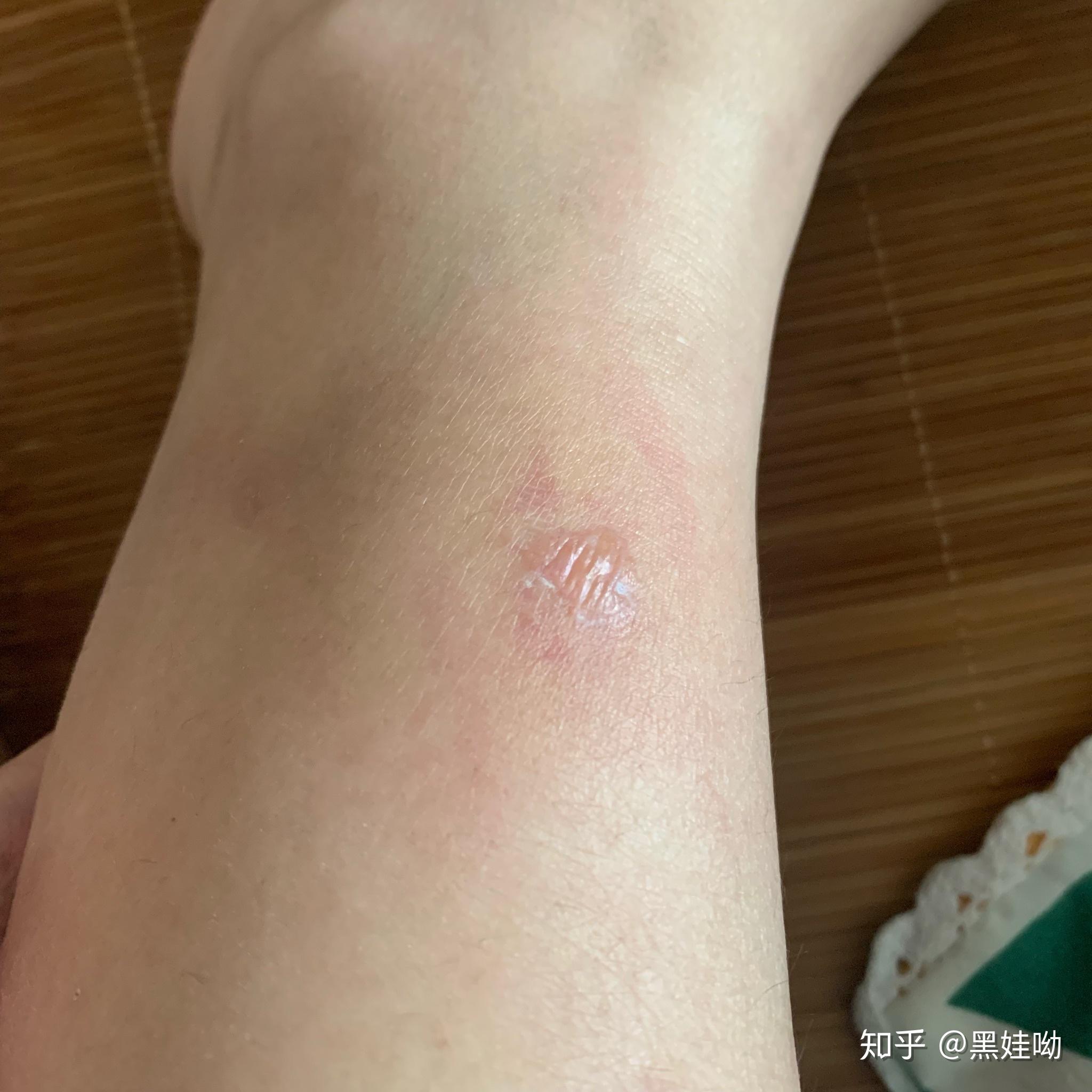 我的腿被蚊子咬得体无完肤(带图)，怎样有效地消除蚊子印？ - 知乎