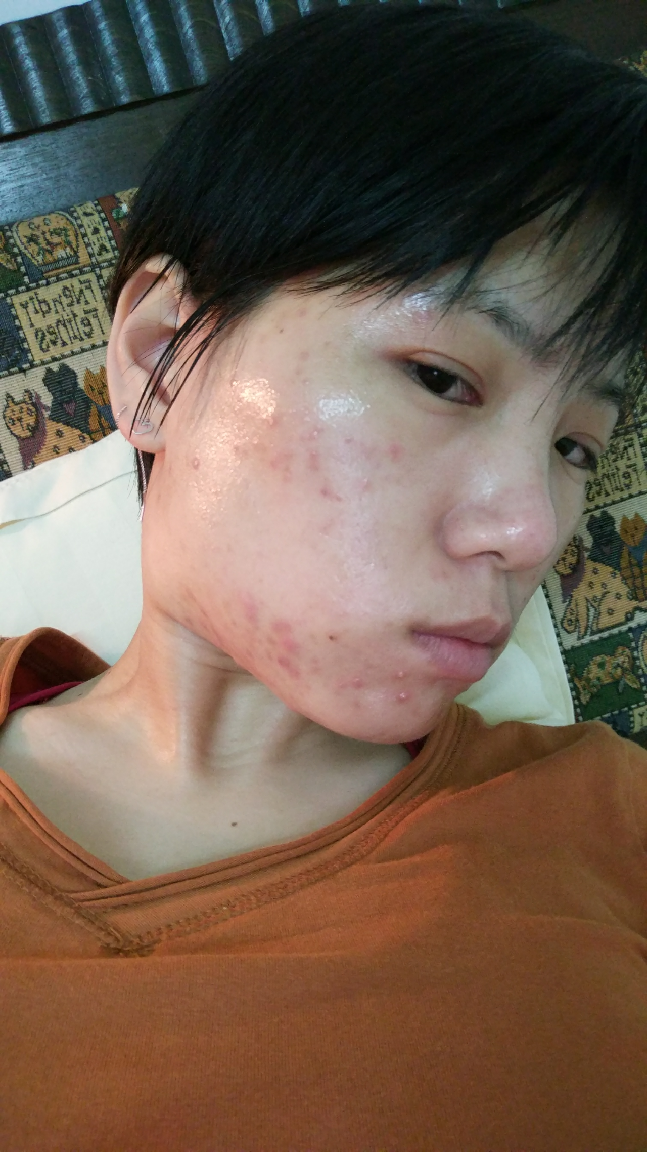 使用阿帕达林凝胶去痘