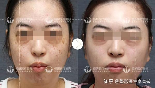 德国rubystar红宝石激光色素性皮肤解决专家