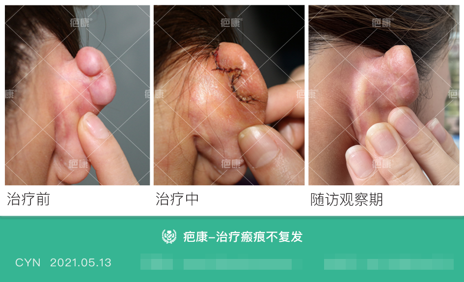 注意穿耳洞养护不当容易造成瘢痕疙瘩