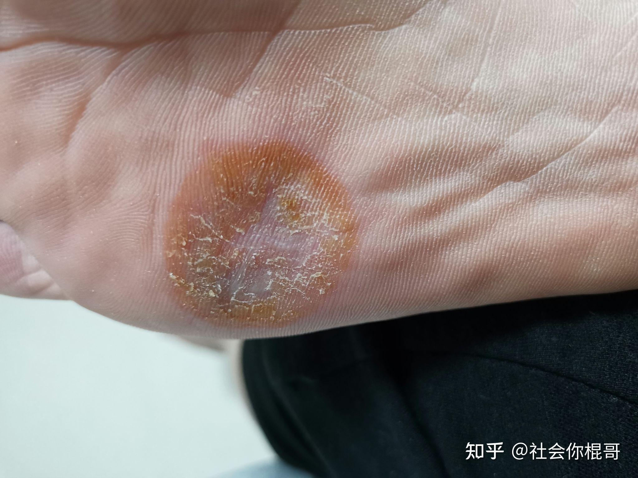 切身体会碘酊治疗重度跖疣