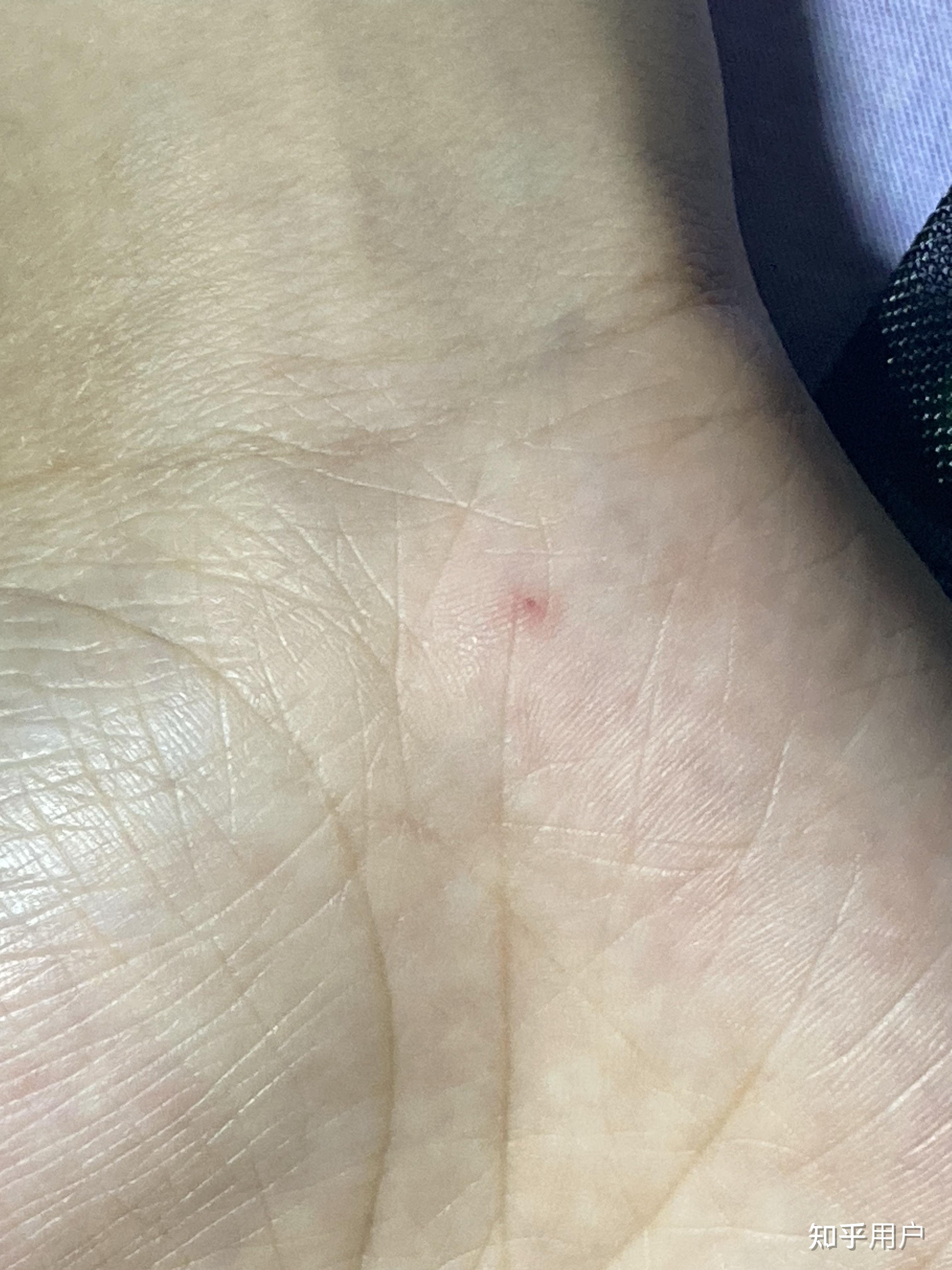 手指上长了一个针眼大的小红点 感觉像血管 一按就消失 松开就又出现