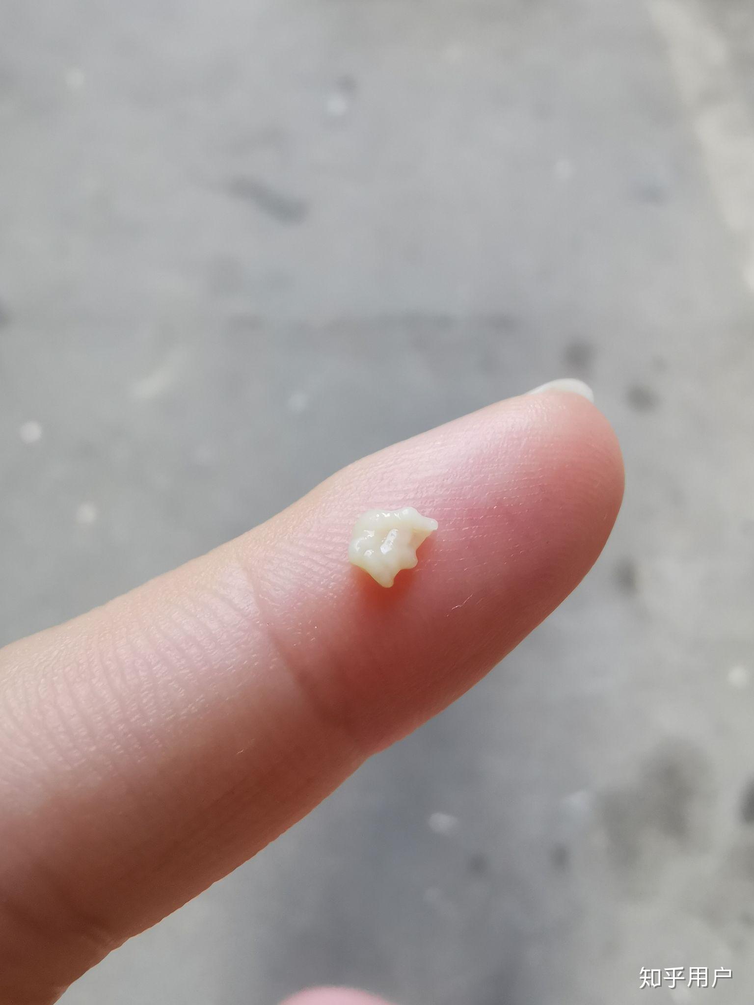 你见过最大的扁桃体结石有多大