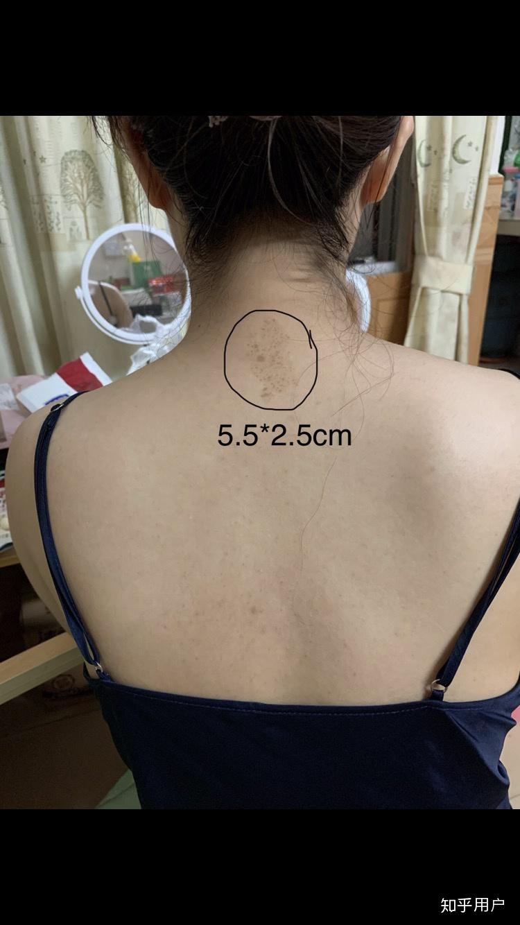 脖子后面黑黑的斑点是什么