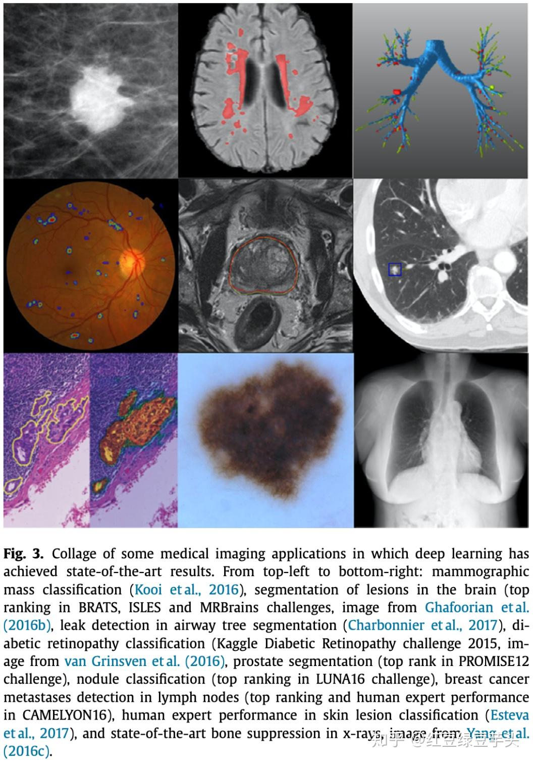 《A Survey On Deep Learning In Medical Image...》简译 - 知乎