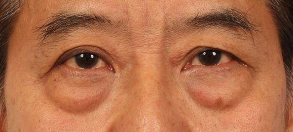 眼袋长出来了能自己消下去吗