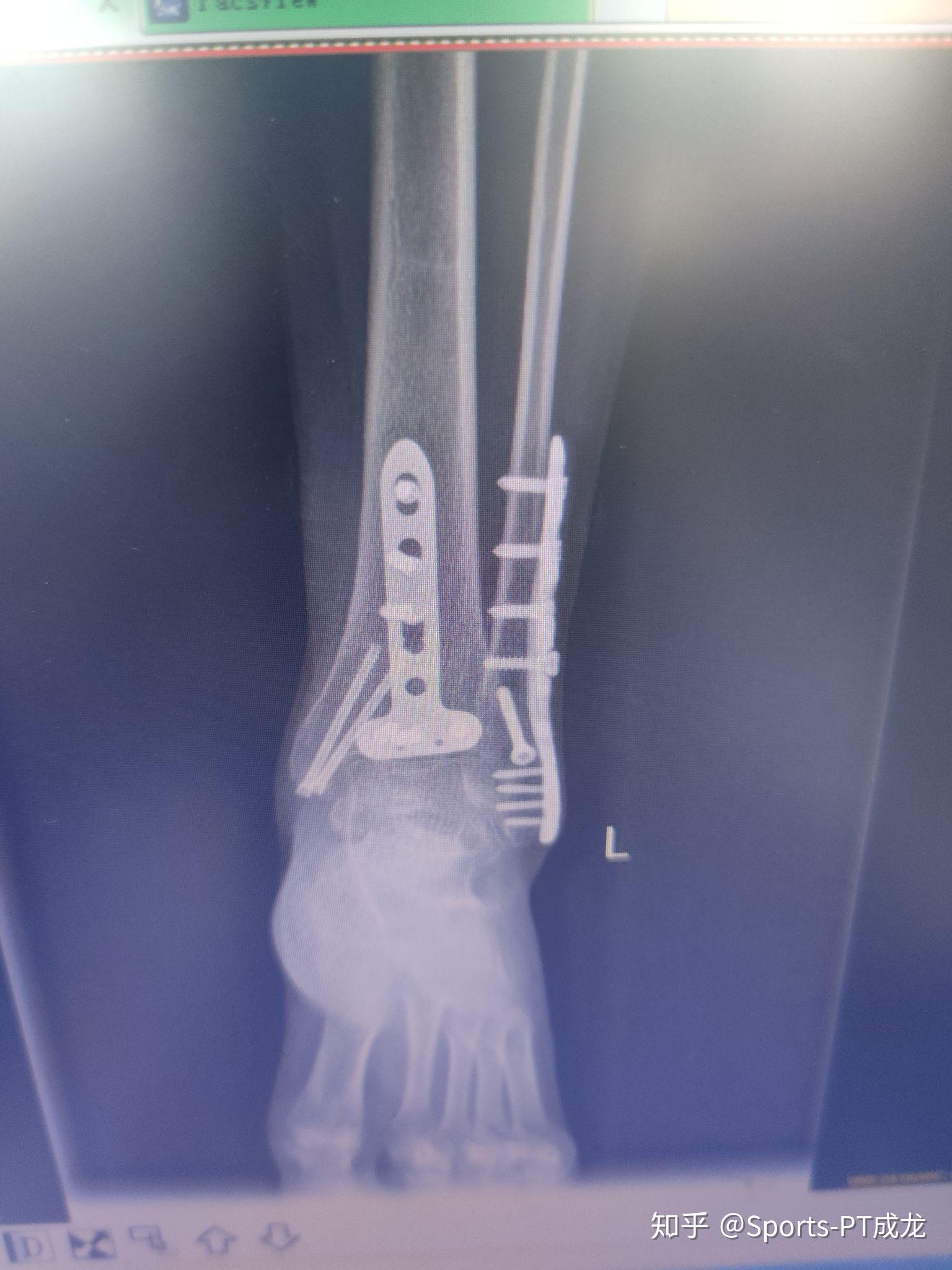 足踝韧带重建手术—全过程记录持续更新 - 知乎