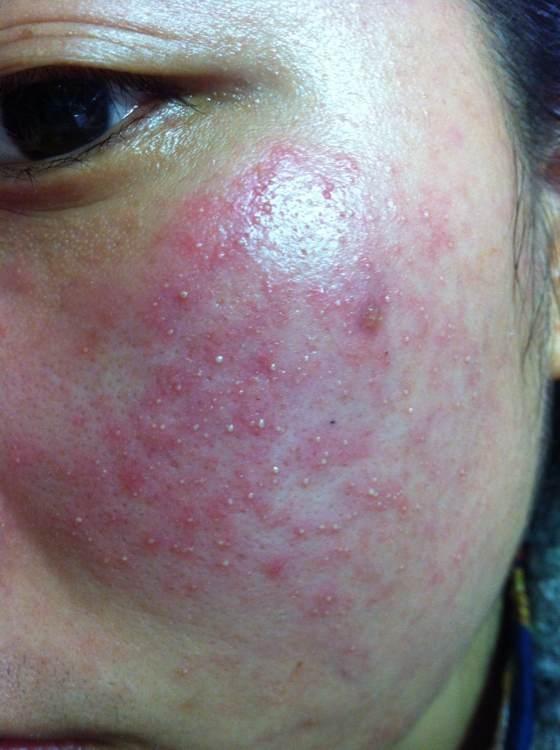 激素脸起疹子是排毒吗多久下去