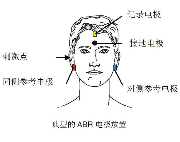 如何理解听觉脑干诱发电位？ - 知乎