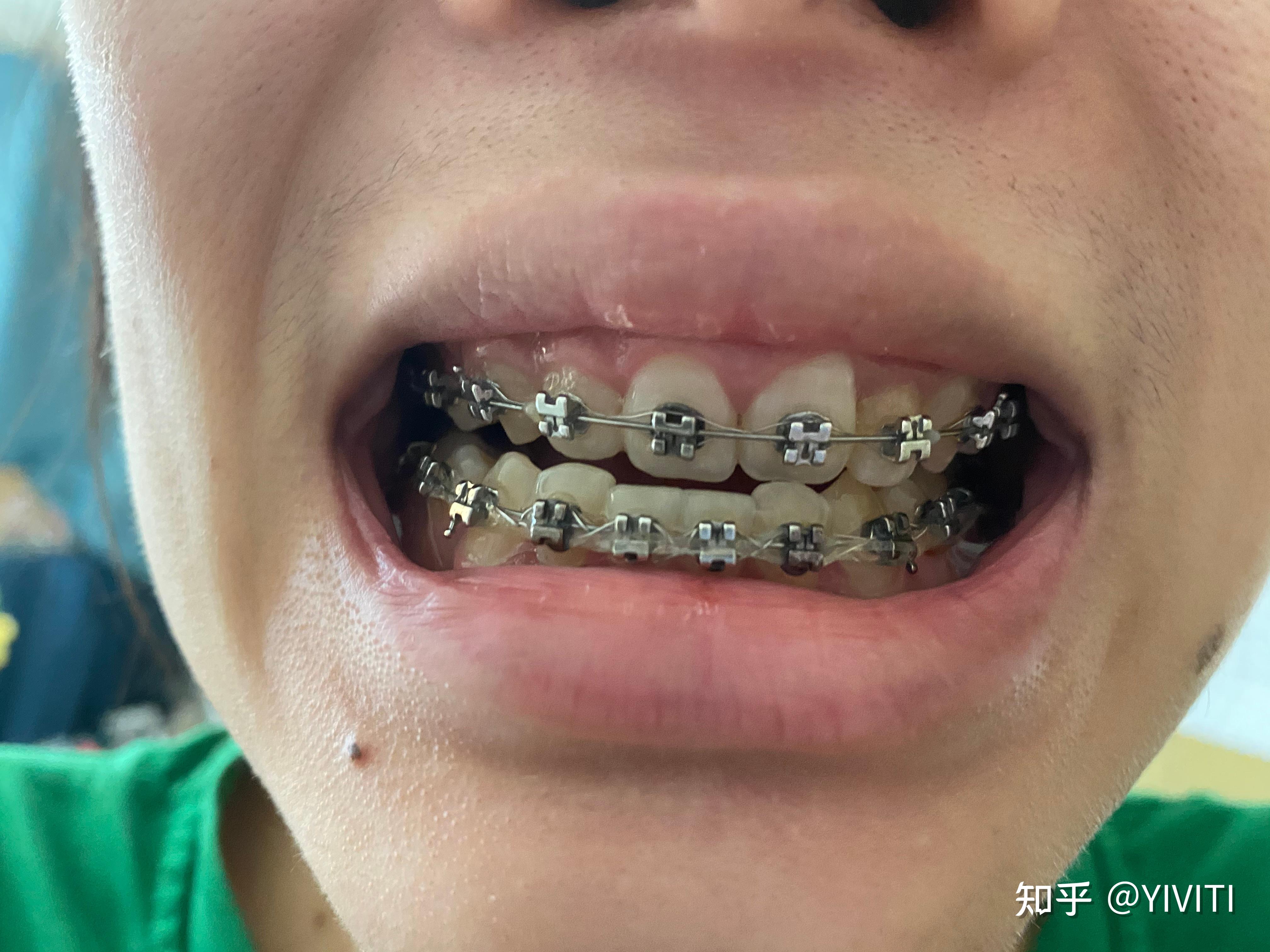 记录我在上海正畸矫正牙整牙的过程