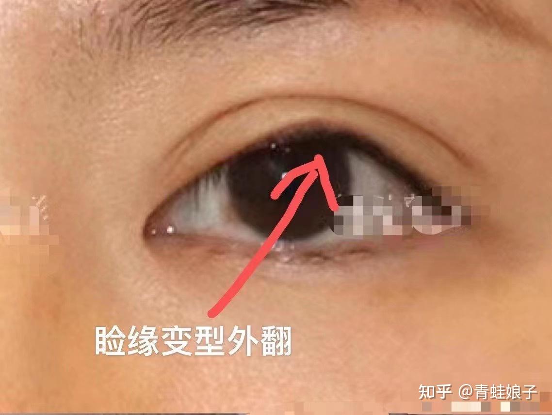 一般都是因为提肌过度,或者双眼皮深导致的,向内牵拉导致眼睑外翻