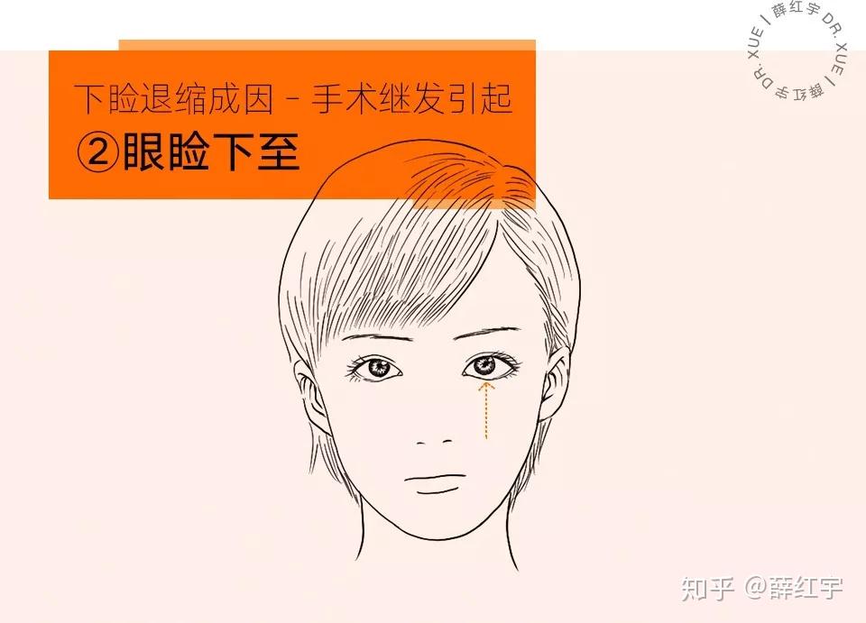 三白眼怎么办? - 知乎