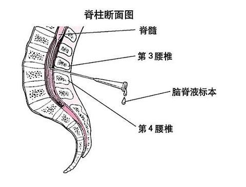 腰穿检查