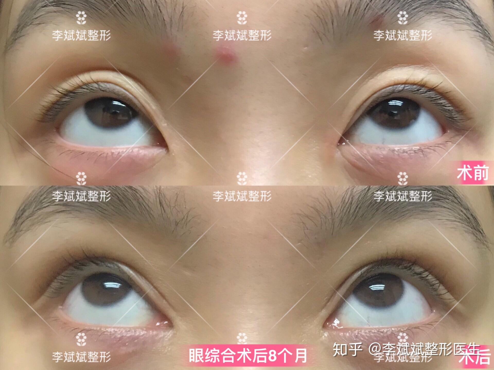 眼部整形实用手册第二讲确定双眼皮手术方案的9大指标