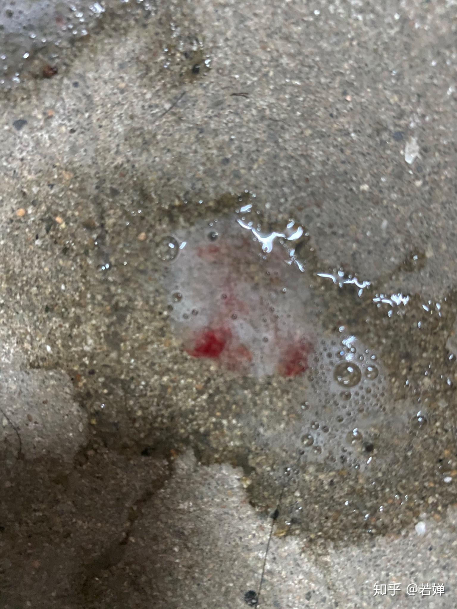 每天早上起床后喉咙经常性出血一定是慢性咽喉炎么