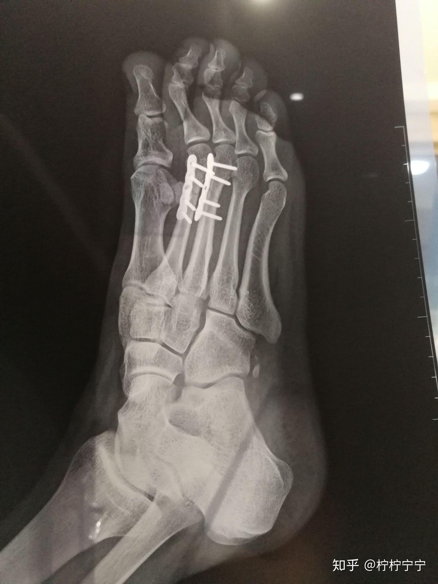 左脚第二跖骨骨折需要多久才能正常走路? - 知乎