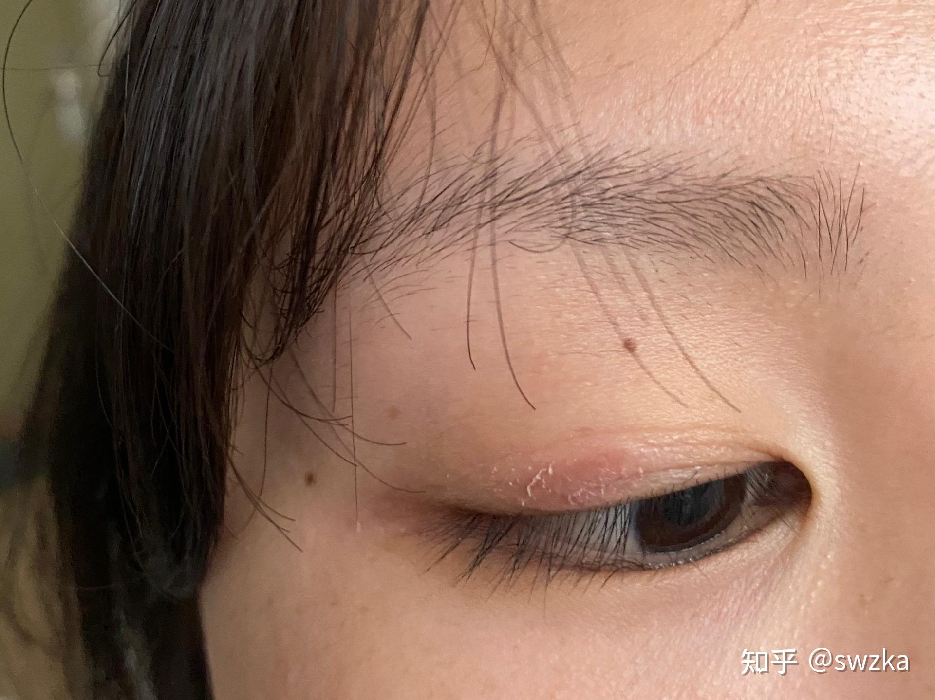 眼皮起皮一个多月了,并且眼角处也有一块起皮(ps.
