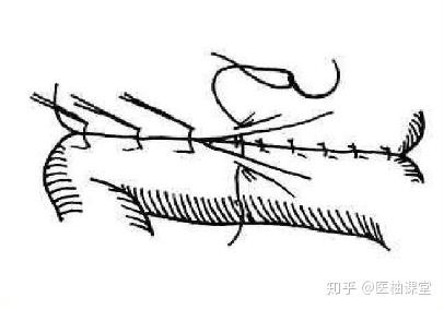 (2)连续全层水平褥式内翻缝合法:又称康乃尔(connells)缝合法