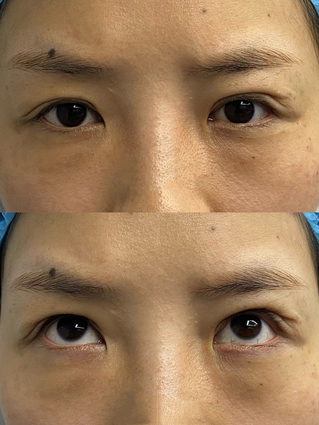 有没有推荐肿泡眼做的比较好的医生呀? - 知乎