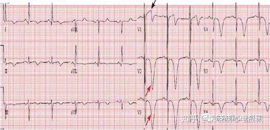 心電圖特徵·qrs波與st-t融合在一起,st段呈尖峰狀抬高或下移,j點