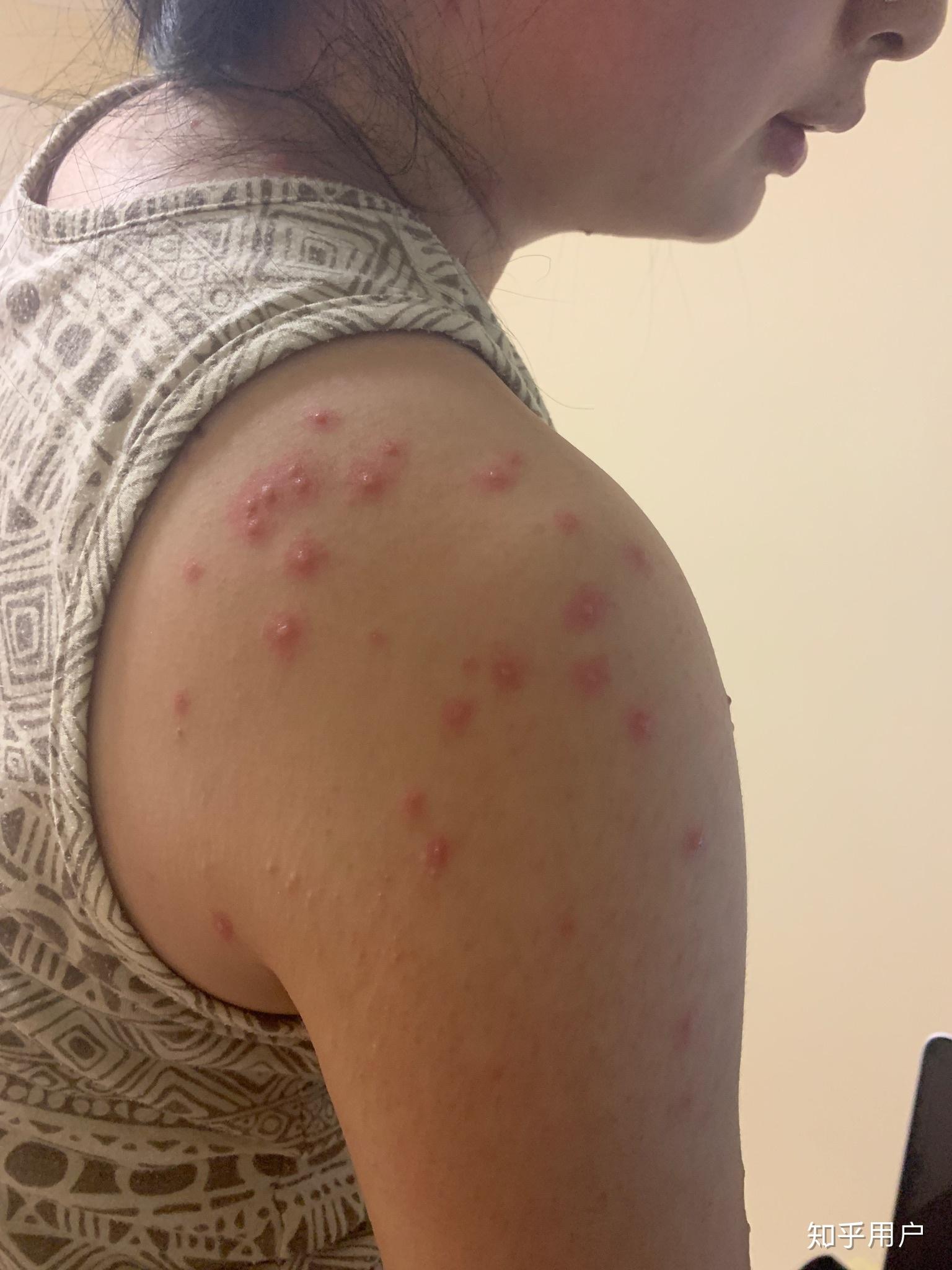 成人长水痘是什么样的经历? - 知乎