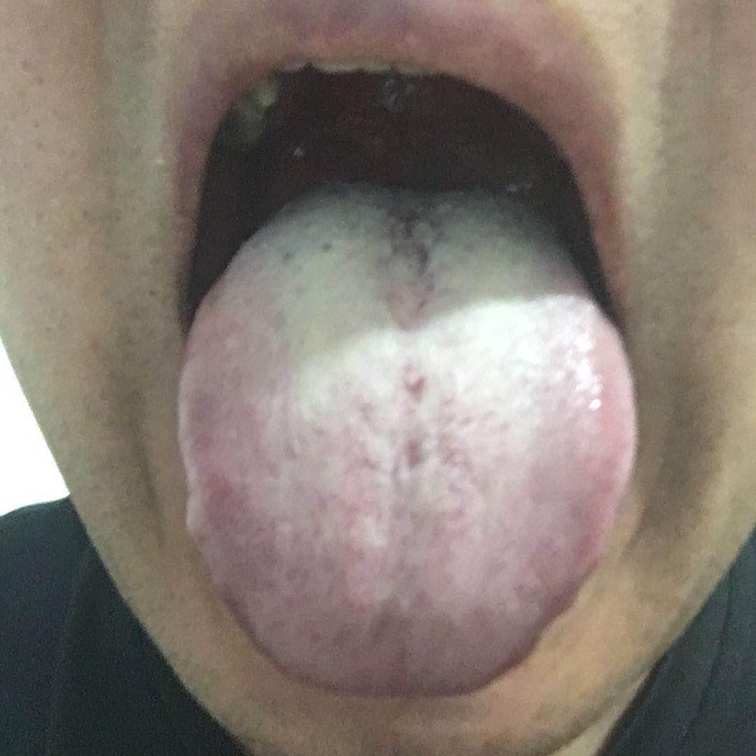 请大家给看看舌苔这样怎么办 知乎