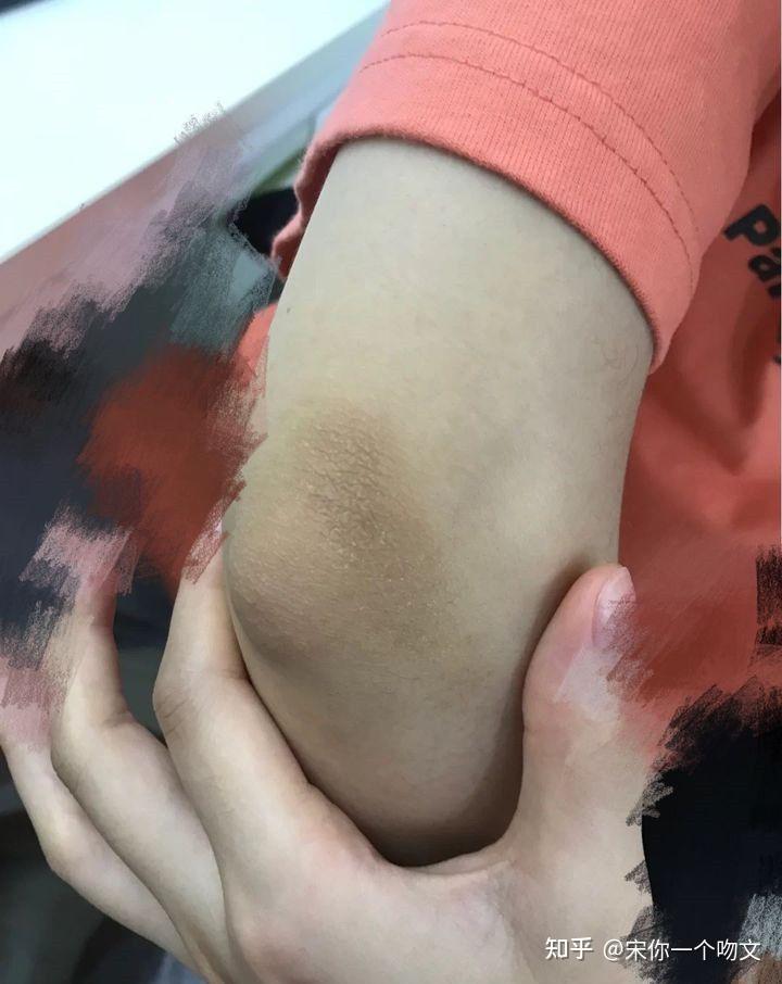 关节黑怎么美白