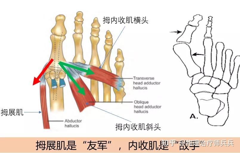 物理治疗师视角又痛又难看跑者的拇外翻bunion