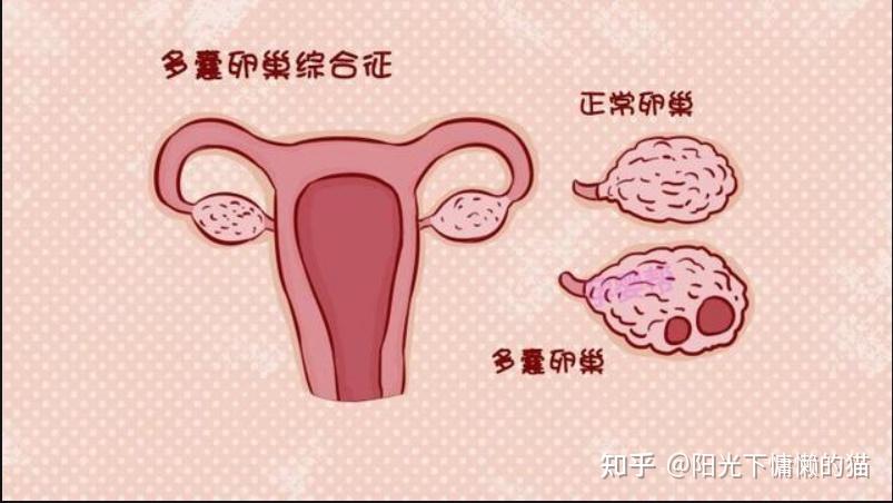 双侧卵巢卵泡增多是多囊吗?多囊如何提高卵子质量? - 知乎