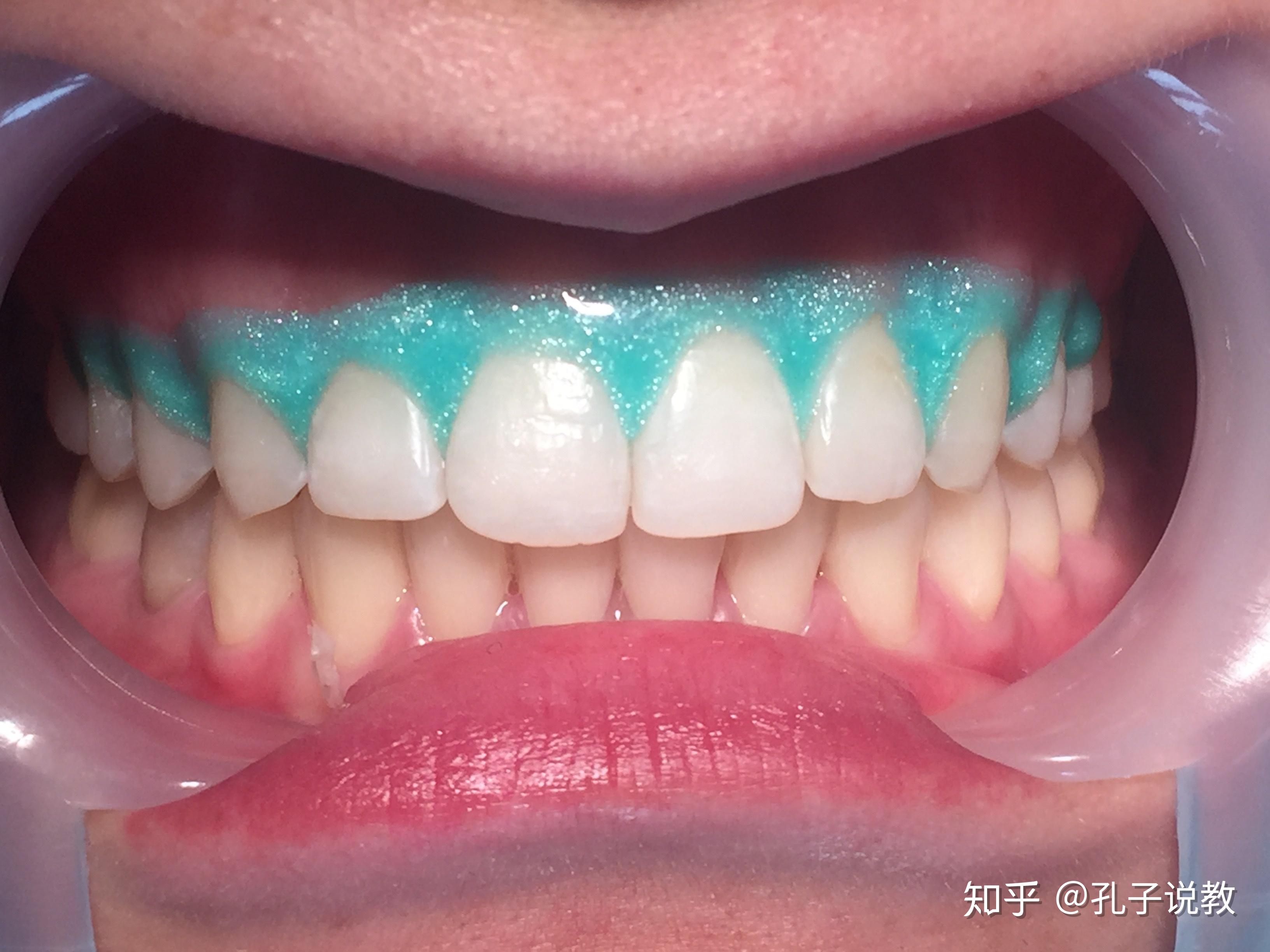 氟斑牙的冷光美白-李晓的博客-KQ88口腔博客