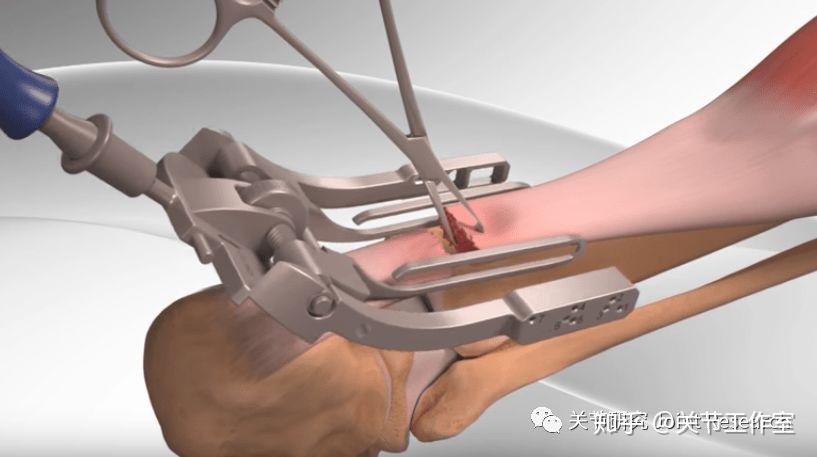 挽救你的弹跳力治疗跟腱断裂