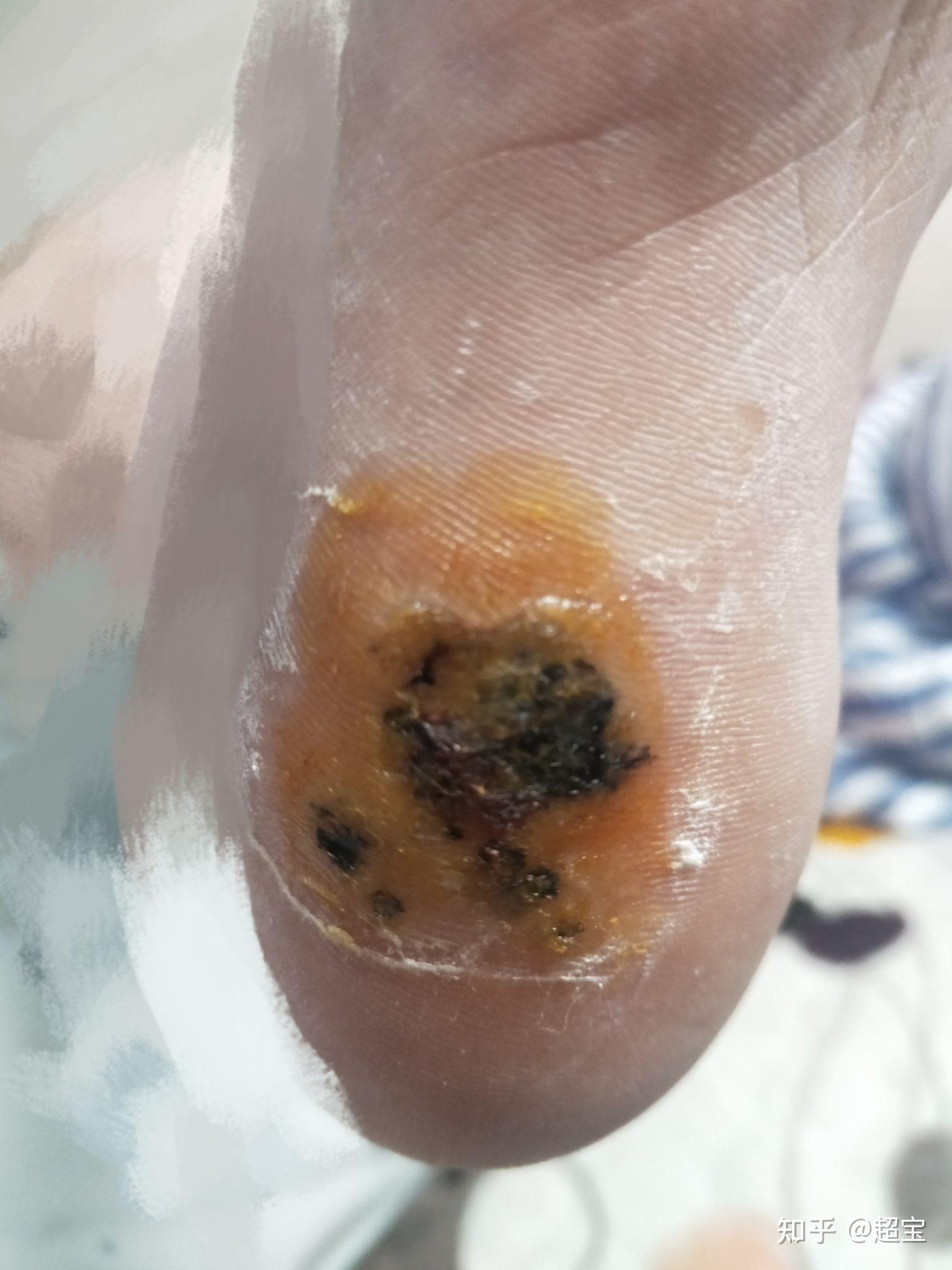 脚底病毒疣治疗记录.希望自己早点好起来! - 知乎