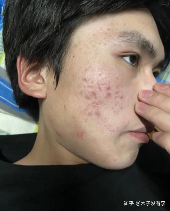 如何科学合理的一个月“消灭”痘印?皮肤科医生教你最正确的男士去痘印攻略!红黑痘印四步搞定!去痘印超猛,男士痘印脸真的有救了! - 知乎