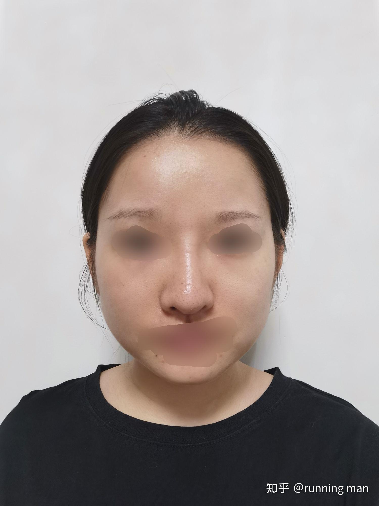 膨体隆鼻后山根高假怎么办? - 知乎