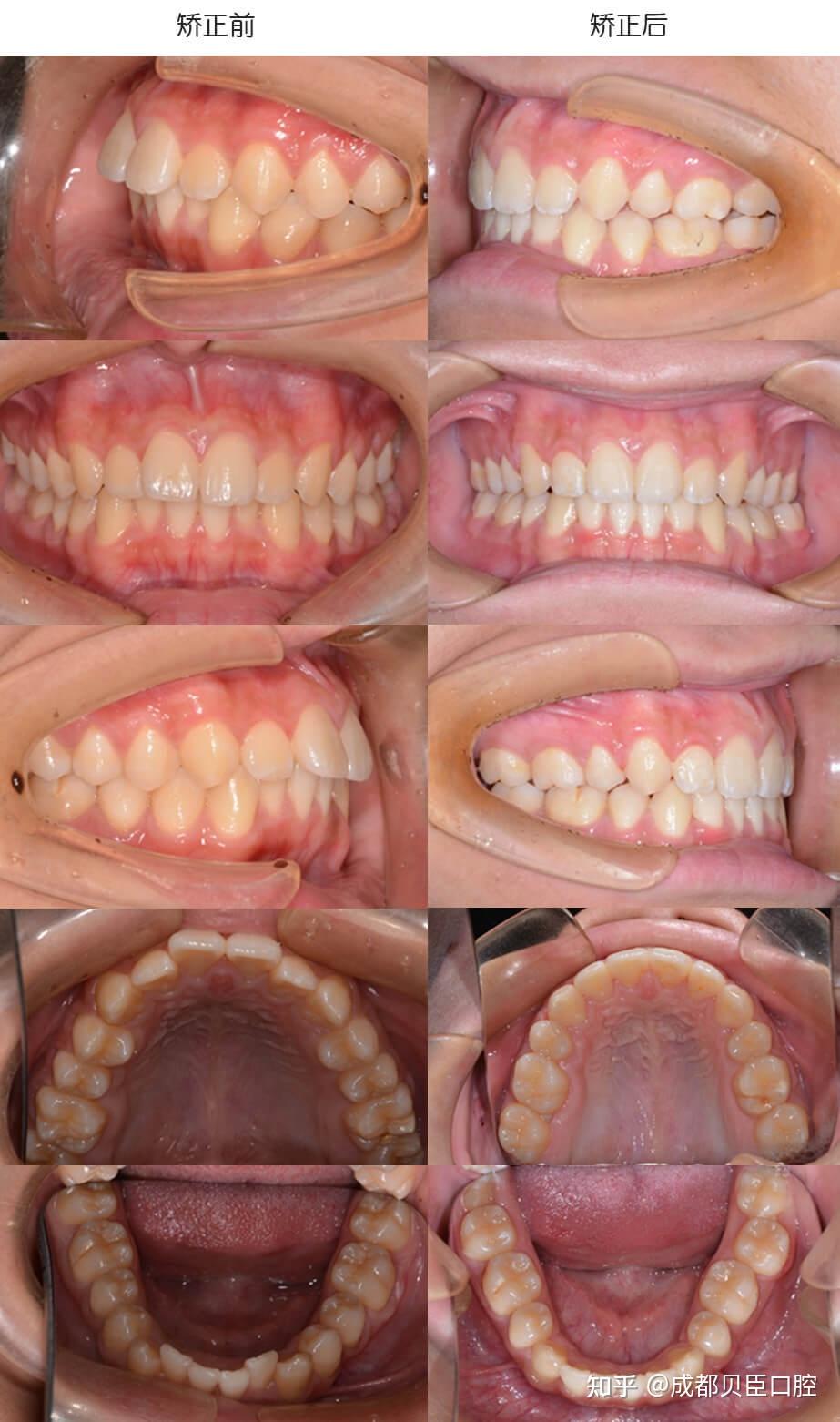 前牙深覆盖的求美者一般伴有上牙唇倾的状况,有时还有牙列拥挤.