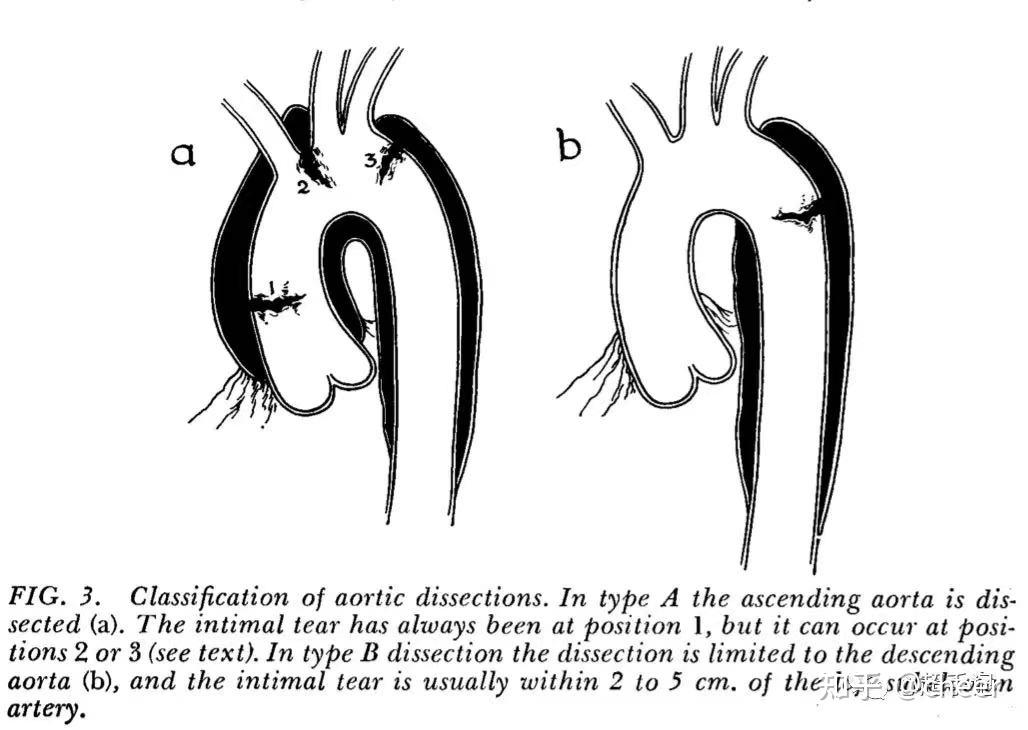 对主动脉夹层分型的一点疑惑及答案 - 知乎