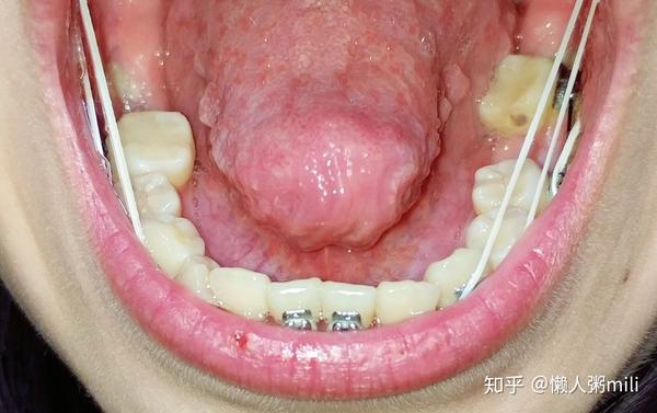 24岁拔磨牙大牙智齿前移替代7号牙牙齿矫正记录 知乎