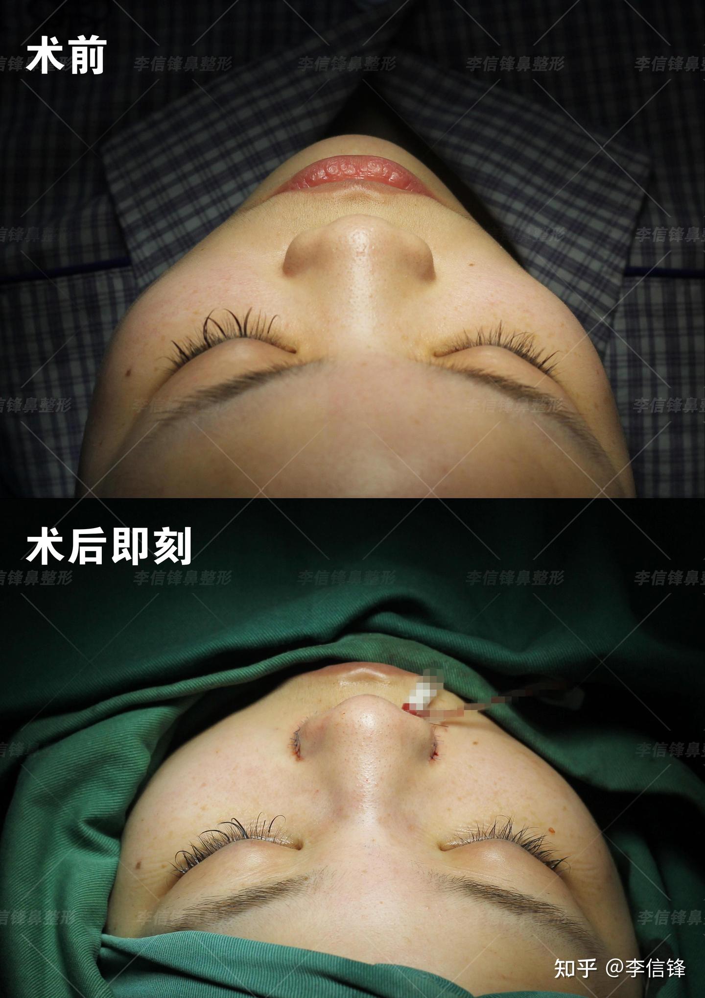 塌鼻、面中部凹陷案例术后即刻对比—深圳李信锋隆鼻整形案例分享 - 知乎