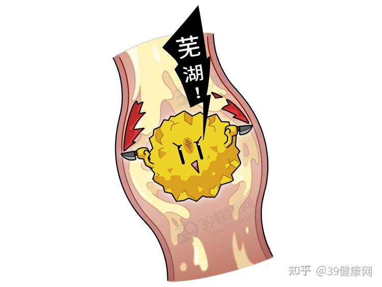 男人排出尿结石比生孩子还痛尿结石是怎么来的