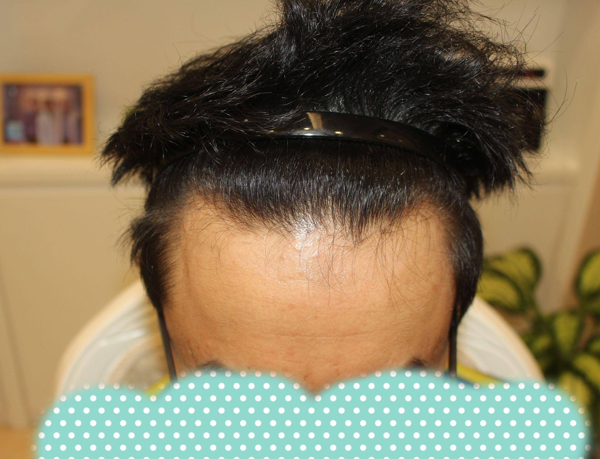 头发移植后有伤疤有什么补救方法？-纹发和植发哪个效果好|纹发需要多少钱|纹发能保持几年|纹发机构--馥植纹发机构