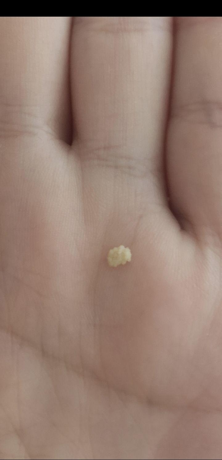 嘴巴里经常咳出吐出黄色颗粒很臭是什么