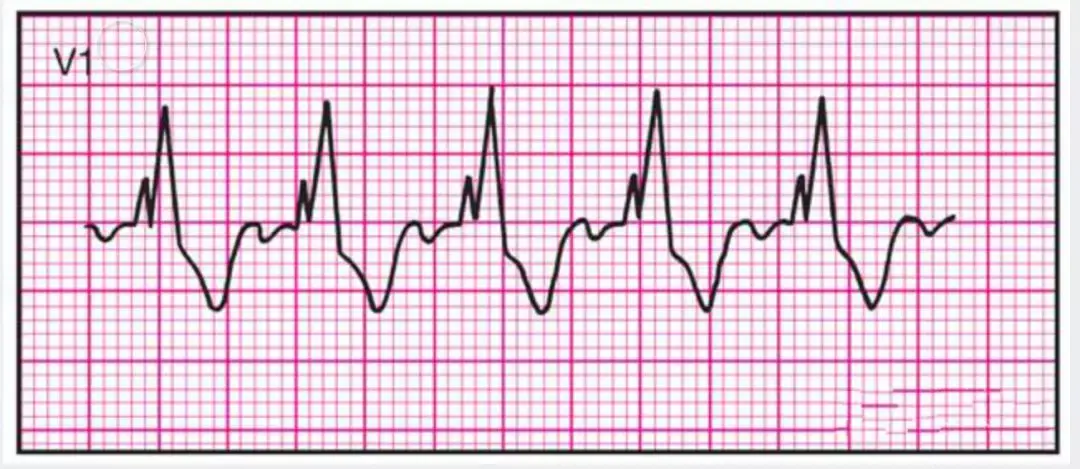 14種異常心電圖的波形特點建議收藏