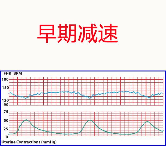 胎心监护变异减速图片