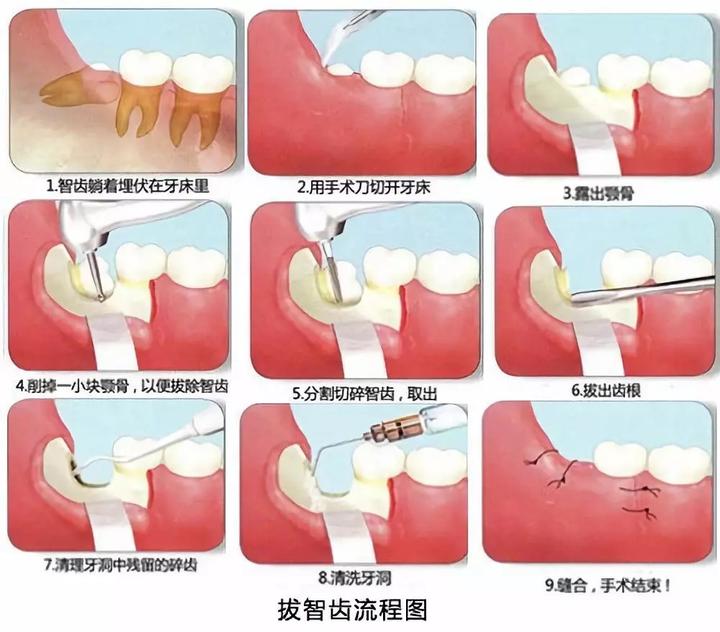 智齿有必要拔掉吗？深圳牙科